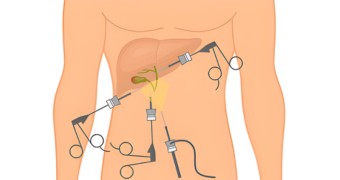 Gallstone Surgery