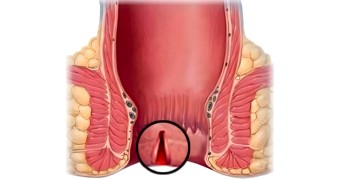 Fissure Surgery