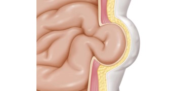 hernia surgery lahore 01