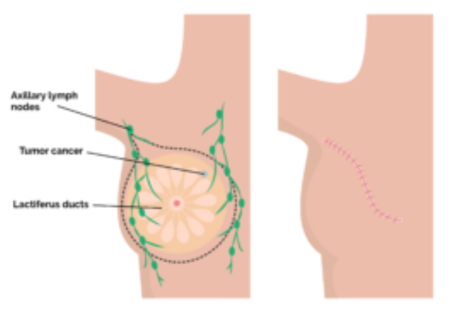 Breast cancer surgery