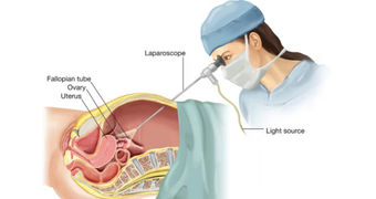 Laparoscopic surgery