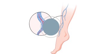 Varicose Vein Surgery